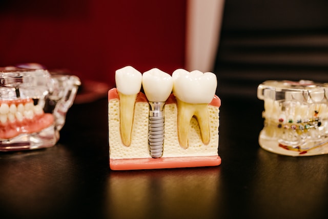 The Advantages of Collingwood Dental Implants Over Conventional Dentures